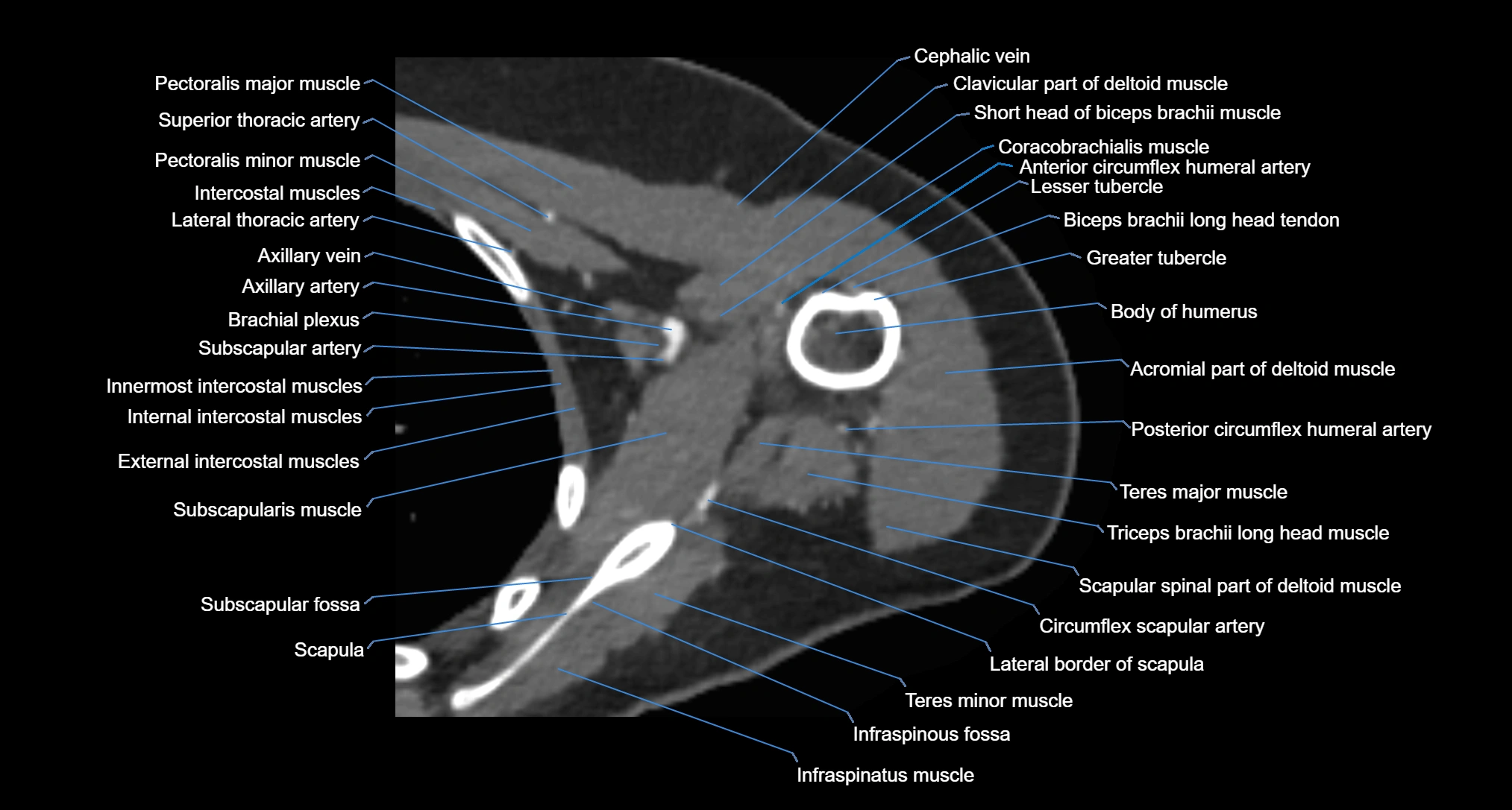 CT Shoulder axial cross sectional anatomy labelled radiology image -00047.webp